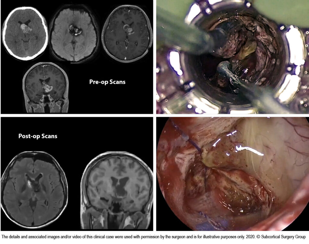 3rd Ventricular Cavernous Malformation – Video Case Review-SSG-graphics